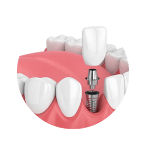 Implant Model