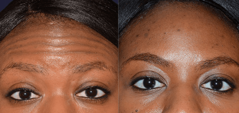 Botox Before and After