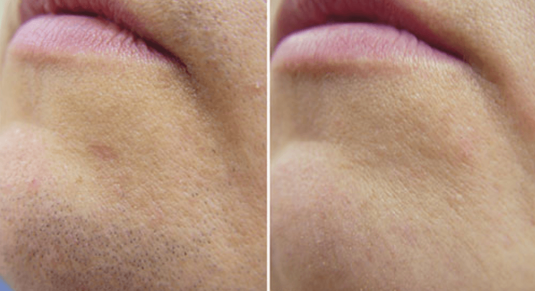 Laser Hair Removal
