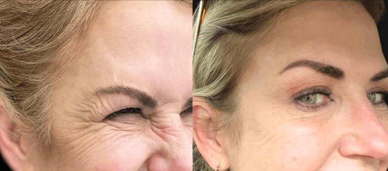 Botox for Fine Lines