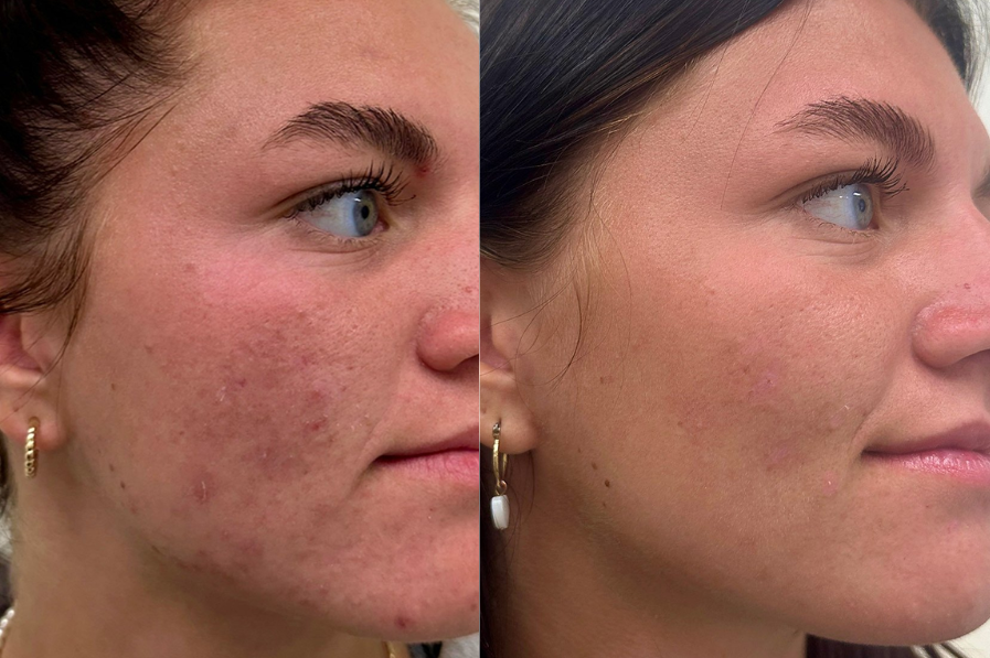 Microneedling Therapy