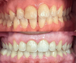 Before and After Bracket and Wire (2) (1)