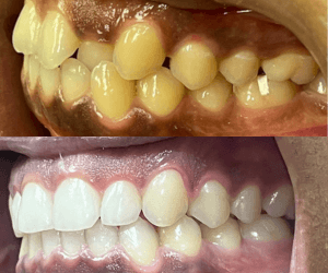 Before and After Bracket and Wire (3) (1)