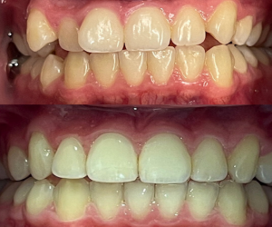 Before_after_tri